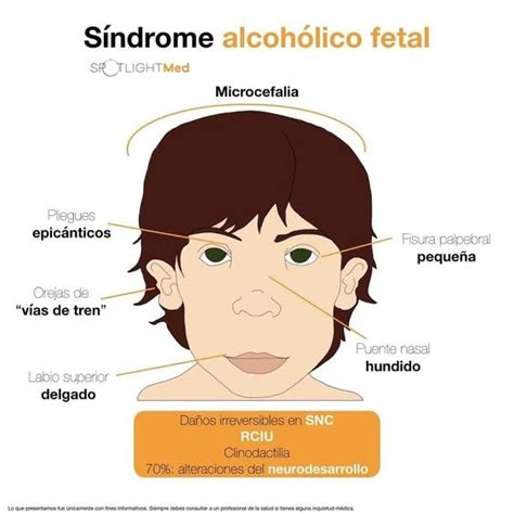 Datos sobre el Síndrome Alcohólico Fetal