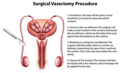 Infografía del procedimiento de vasectomía