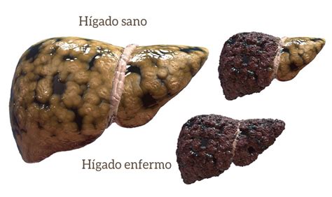 higado dañado por el alcohol